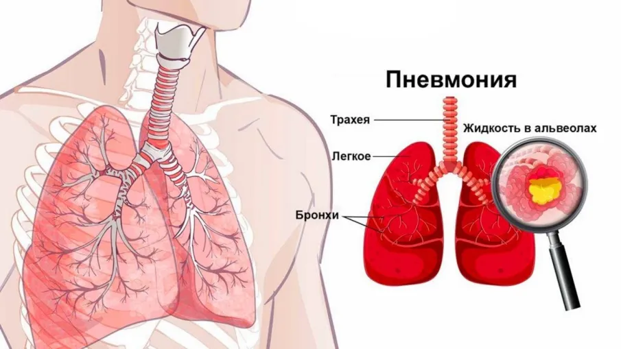Рекомендации по профилактике пневмонии